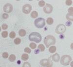 Sfärocyter Sfärocyter. Mikroskopbild.